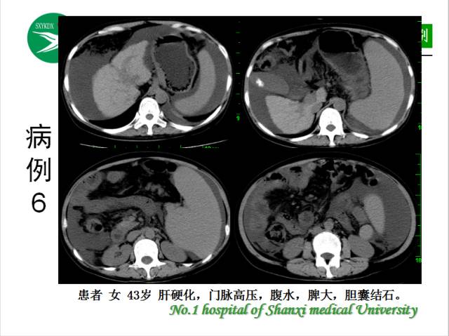 【PPT】腹腔积液的良恶性表现与鉴别