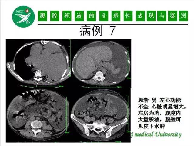 【PPT】腹腔积液的良恶性表现与鉴别