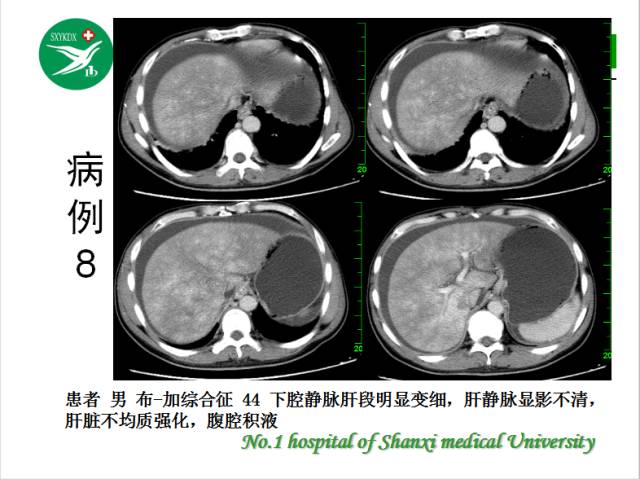【PPT】腹腔积液的良恶性表现与鉴别