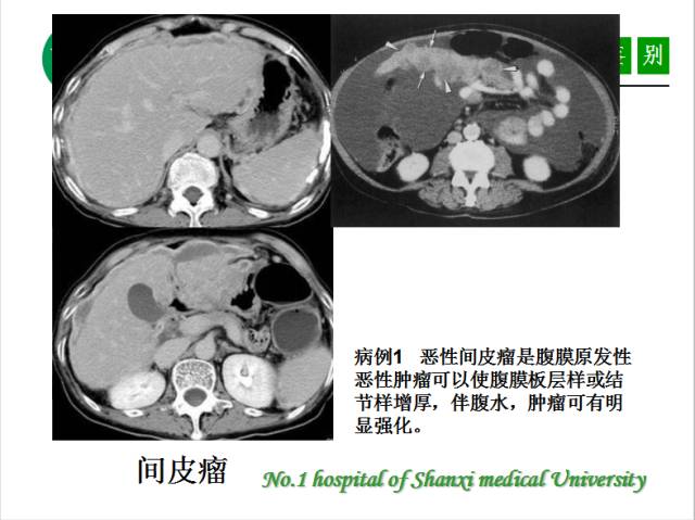 【PPT】腹腔积液的良恶性表现与鉴别