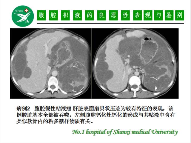 【PPT】腹腔积液的良恶性表现与鉴别