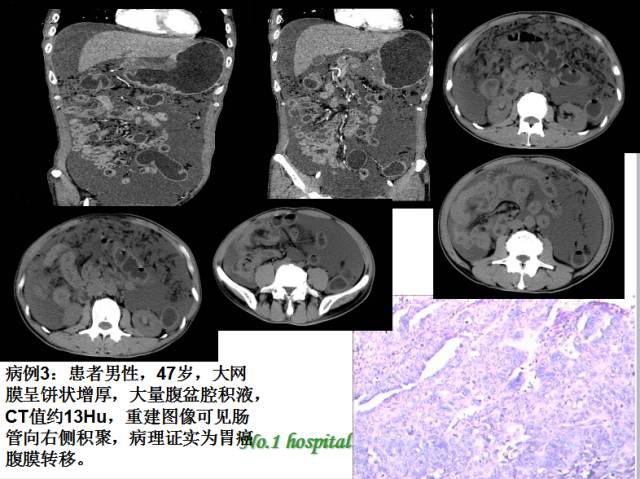 【PPT】腹腔积液的良恶性表现与鉴别