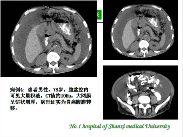 【PPT】腹腔积液的良恶性表现与鉴别