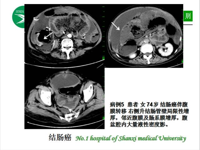 【PPT】腹腔积液的良恶性表现与鉴别