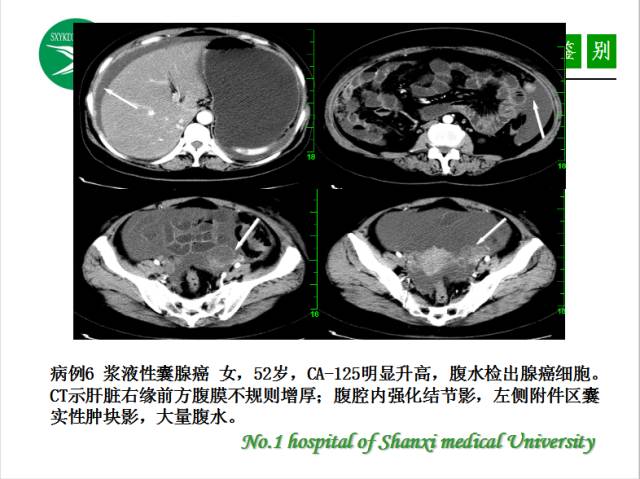 【PPT】腹腔积液的良恶性表现与鉴别