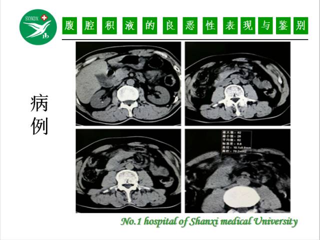 【PPT】腹腔积液的良恶性表现与鉴别