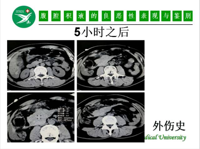 【PPT】腹腔积液的良恶性表现与鉴别