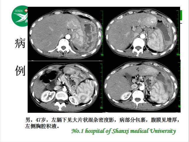 【PPT】腹腔积液的良恶性表现与鉴别