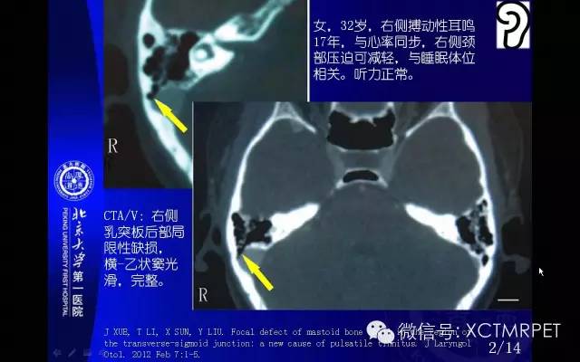 【PPT】心肌桥