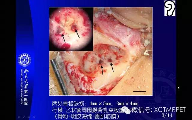 【PPT】心肌桥