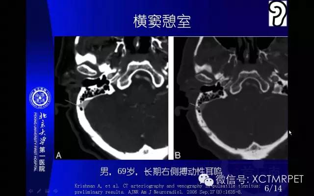 【PPT】心肌桥