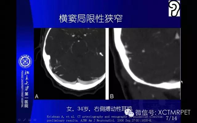 【PPT】心肌桥