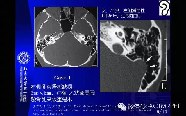 【PPT】心肌桥
