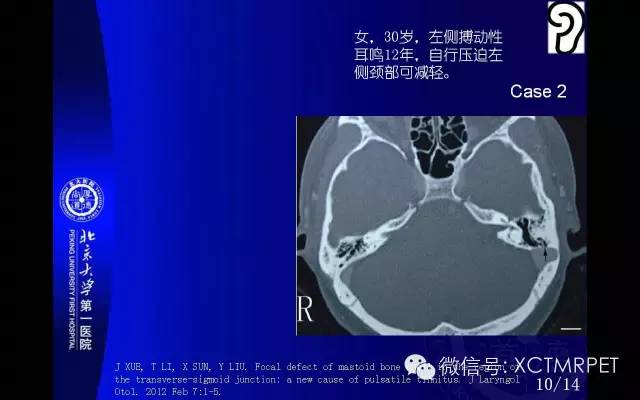 【PPT】心肌桥