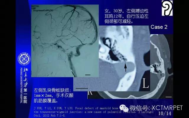 【PPT】心肌桥
