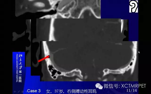 【PPT】心肌桥