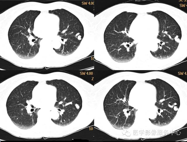 【病例】肺动静脉畸形1例CT影像表现