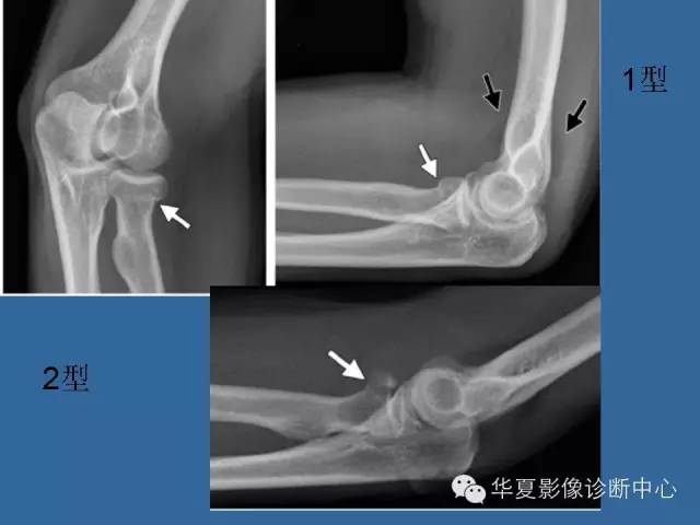 【PPT】肘关节外伤影像学评价