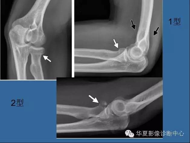 【PPT】肘关节外伤影像学评价