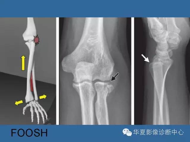 【PPT】肘关节外伤影像学评价