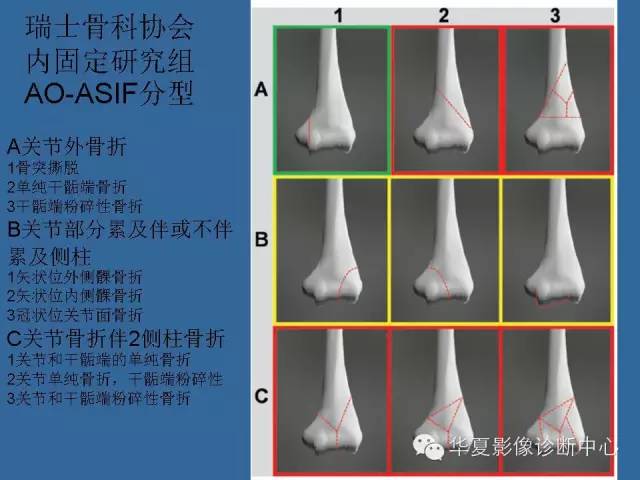 【PPT】肘关节外伤影像学评价