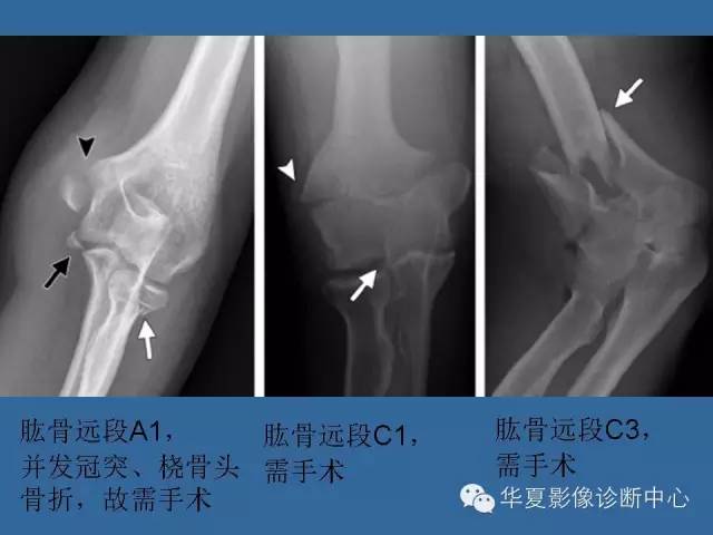 【PPT】肘关节外伤影像学评价