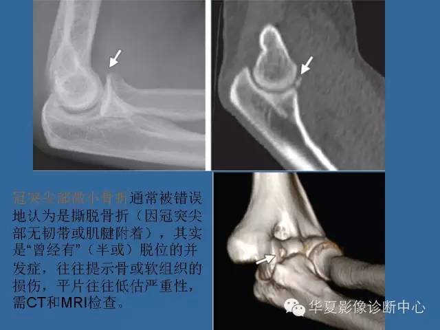 【PPT】肘关节外伤影像学评价