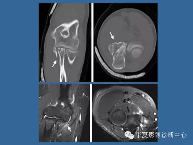 【PPT】肘关节外伤影像学评价