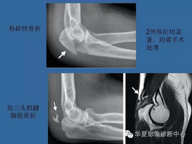 【PPT】肘关节外伤影像学评价