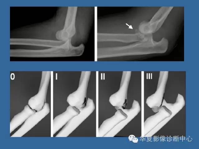 【PPT】肘关节外伤影像学评价