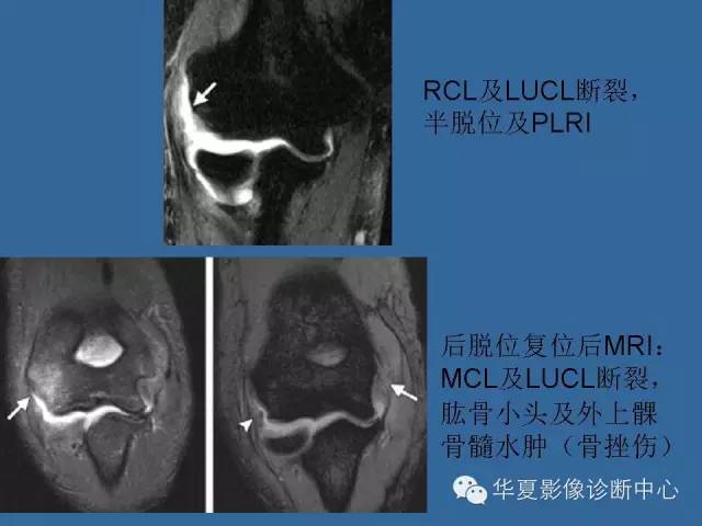 【PPT】肘关节外伤影像学评价