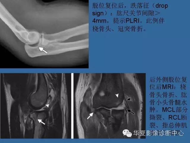 【PPT】肘关节外伤影像学评价