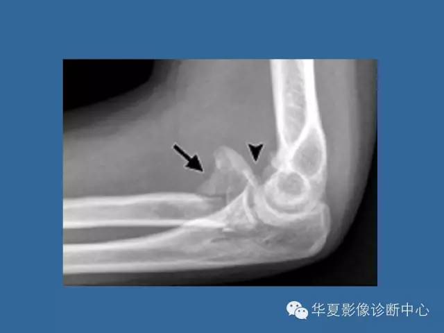 【PPT】肘关节外伤影像学评价