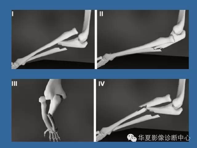 【PPT】肘关节外伤影像学评价