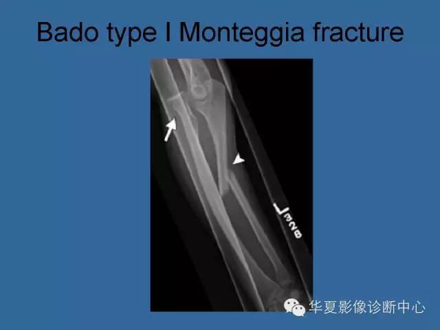 【PPT】肘关节外伤影像学评价