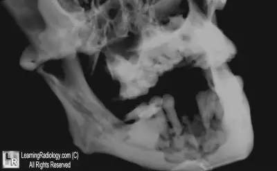 【病例】 颌骨双磷酸盐相关性骨坏死1例