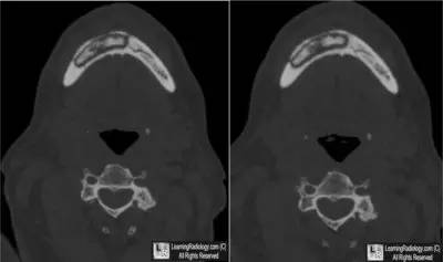 【病例】 颌骨双磷酸盐相关性骨坏死1例 【病例】 颌骨双磷酸盐相关性骨坏死1例