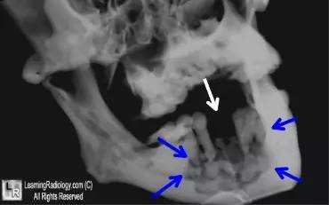 【病例】 颌骨双磷酸盐相关性骨坏死1例 【病例】 颌骨双磷酸盐相关性骨坏死1例