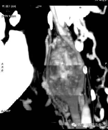 【病例】颈动脉体瘤1例CT影像表现
