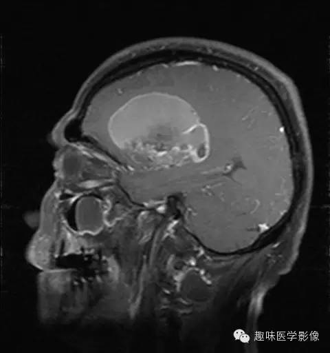 【病例】胶质母细胞瘤1例MR影像表现 【病例】胶质母细胞瘤1例MR影像表现