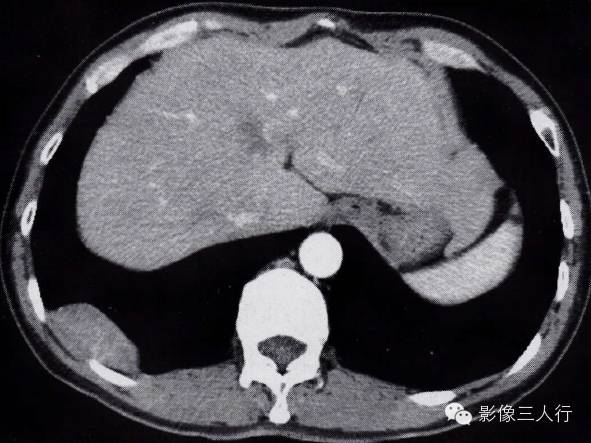“胸膜间皮瘤 ”如何诊断？
