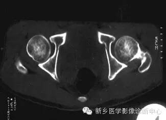 股骨头缺血坏死的影像学分级和图解