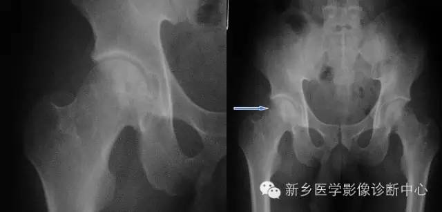 股骨头缺血坏死的影像学分级和图解