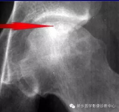 股骨头缺血坏死的影像学分级和图解