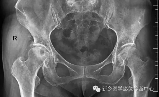 股骨头缺血坏死的影像学分级和图解