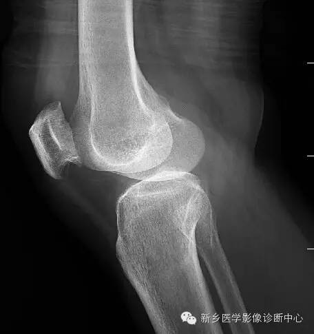 膝关节骨性关节炎分级和分型 膝关节骨性关节炎分级和分型