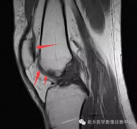 膝关节骨性关节炎分级和分型 膝关节骨性关节炎分级和分型