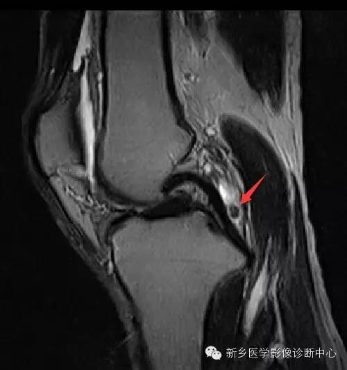 膝关节骨性关节炎分级和分型 膝关节骨性关节炎分级和分型