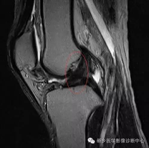 膝关节骨性关节炎分级和分型 膝关节骨性关节炎分级和分型