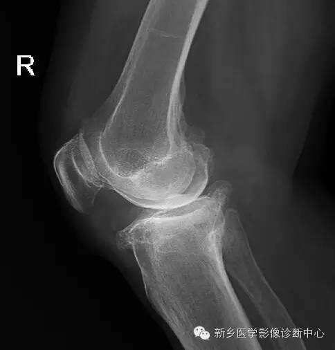 膝关节骨性关节炎分级和分型 膝关节骨性关节炎分级和分型